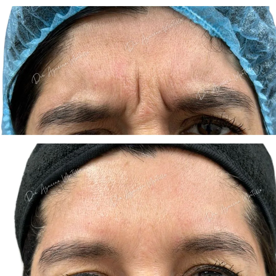 Resultado botox entrecejo — antes y después