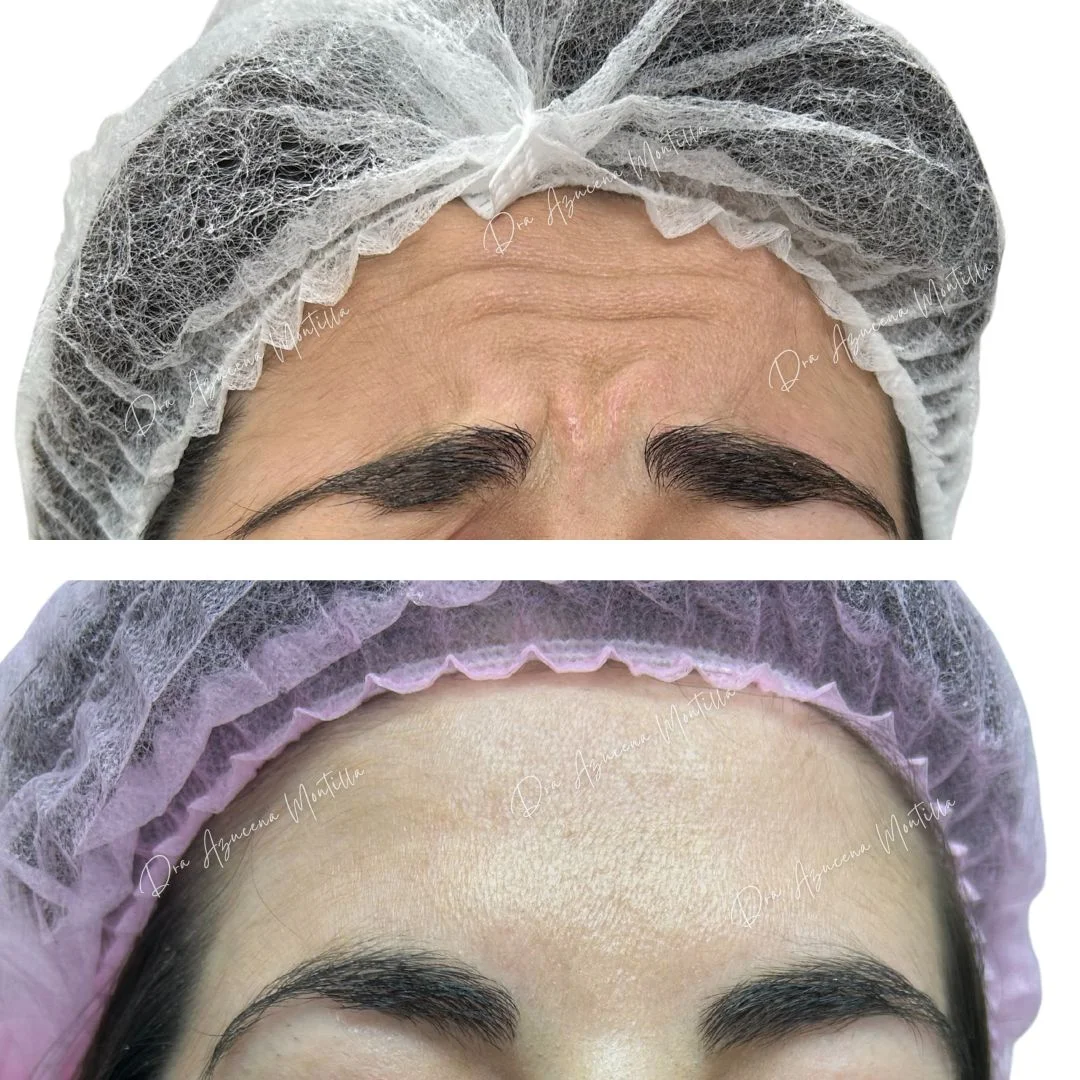 Resultado botox — antes y después