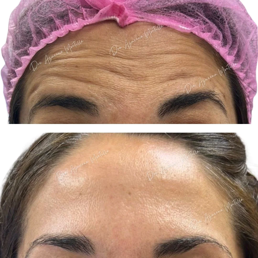 Resultado botox — antes y después