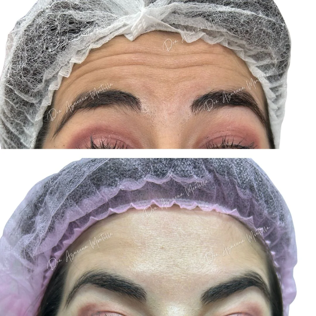Resultado botox — antes y después