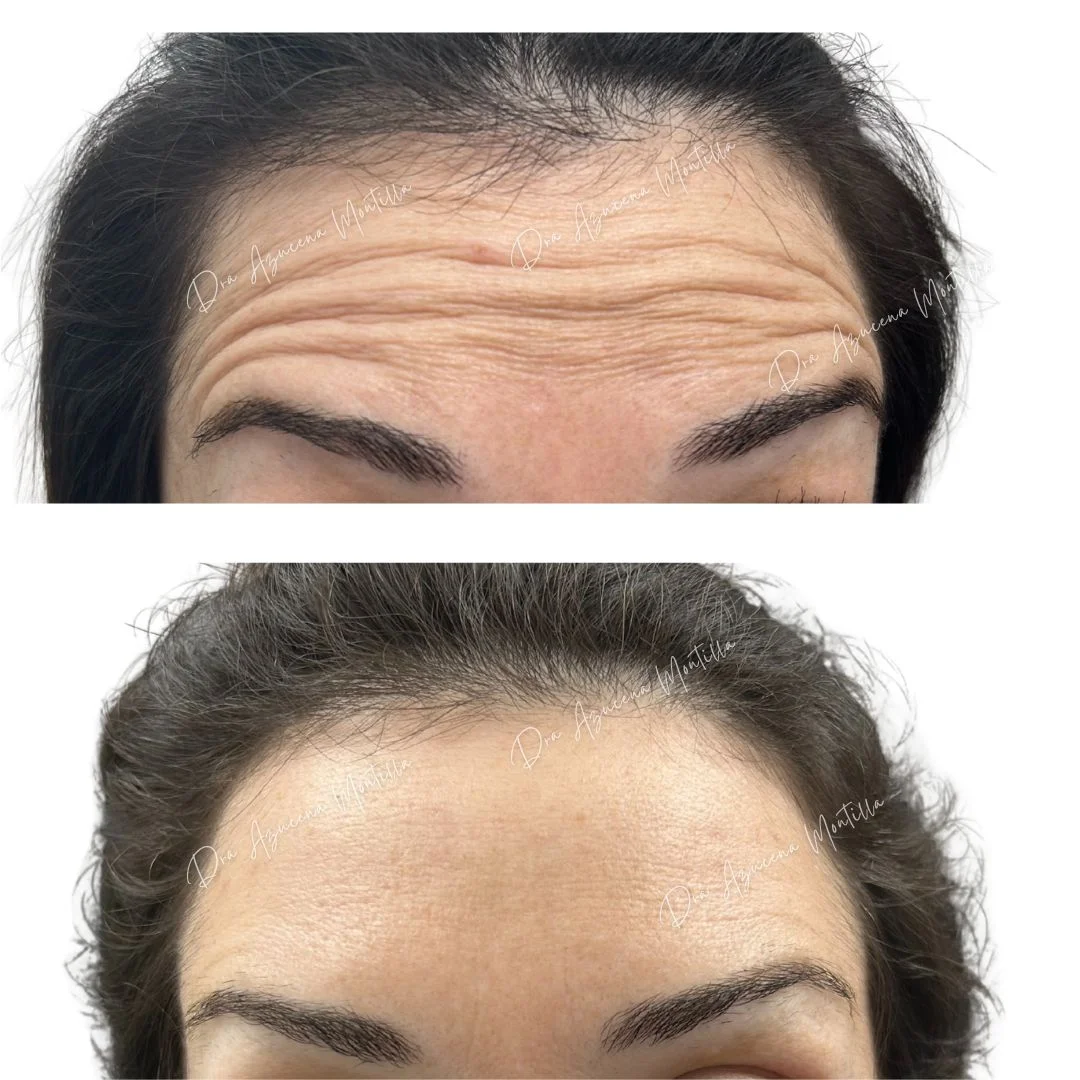 Resultado botox — antes y después